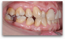 trattamento ortodontico e impiantare per sostituzione dell’incisivo centrale superiore di destra