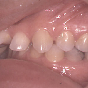 Paziente adulto, grave morso profondo, trattamento ortodontico